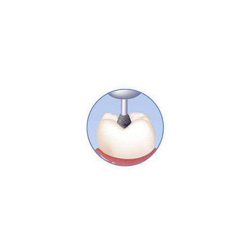 Abrasive Technology T1 2015190 FG Skooter Acorn Medium Grit Diamond Burs 5/Pk